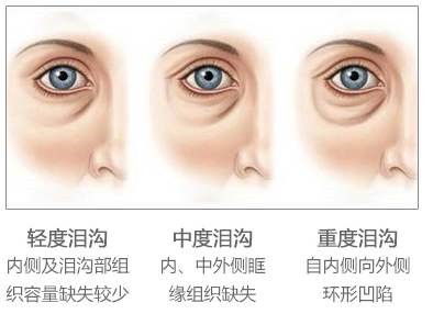 泪沟还有这3种类型,你都知道吗