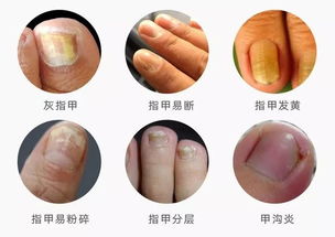 10年顽固灰指甲,久治不愈 用它 让无数国人摆脱灰指甲
