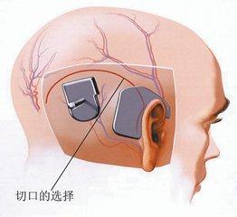 孩子植入人工耳蜗后,是否就可以听到声