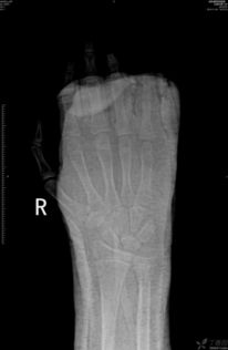右手骨折图片 图片欣赏中心 急不急图文 Jpjww Com