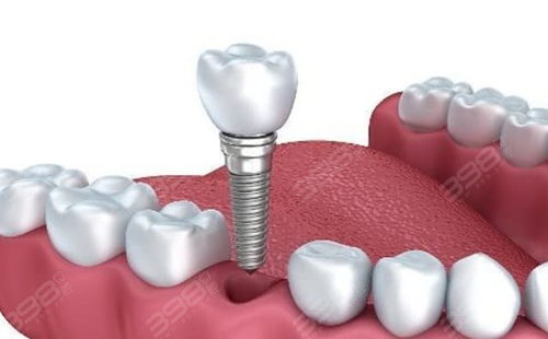 60岁以上老年人种植牙价格表参考,含半口 全口 多颗种牙费用