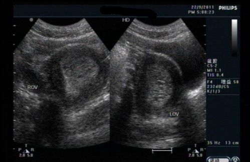 子宫内膜薄由哪些因素造成?能否试管怀孕？