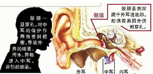 你对鼓膜穿孔了解吗 