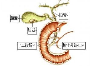 保胆取石适应症