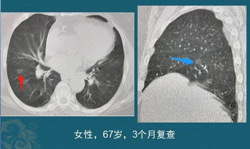 磨玻璃结节1cm,要不要动手术 医生细说肺癌手术时机