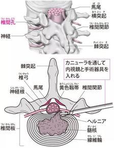 治疗腰椎间盘突出症的手术疗法,应该怎么选 