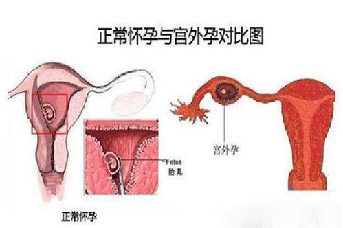 男人梦见宫外孕(男人梦见宫外孕出血)