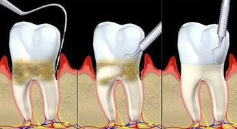 牙周炎不及时治疗的危害 