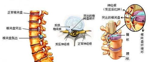 腰间盘突出的原因 腰椎间盘突出是什么原因引起的