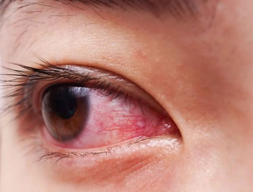 眼睛红血丝多是什么原因,眼睛红血丝多是什么原因怎么治疗
