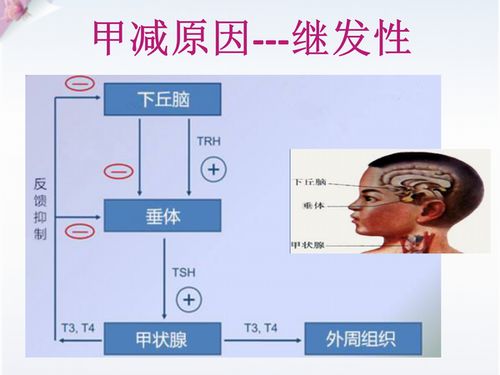 甲状腺功能减退症