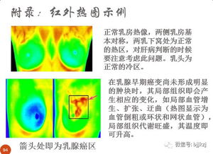 红外线热成像技术：风湿病的快速检测方法