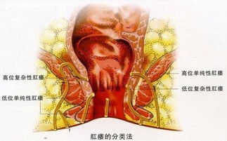 肛瘘的危害都有哪些 