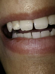 门牙磕了一个很小的口子,磨牙能磨平吗,放大图片可看清 