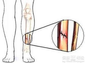 骨折的临床表现和诊断方法