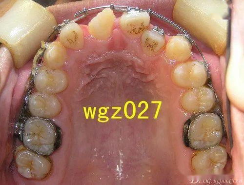 一例上颌中切牙严重扭转矫治经典过程组图