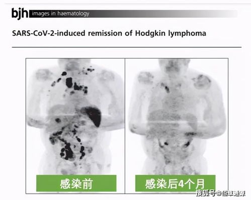 佰草通源见闻 不可思议 癌症晚期患者染新冠4个月后,肿瘤竟然消失了