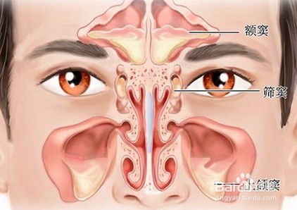 治疗鼻窦炎盐水洗鼻是个好方法 