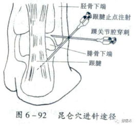 “回抽无血”是什么意思？