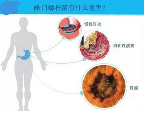 有胃病的人都有幽门螺旋杆菌 一起来戳穿谎言