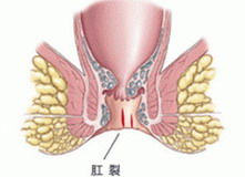 大便时肛门出血是什么问题 