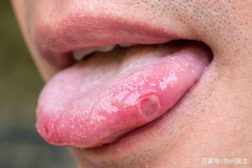 吃饭时总是咬到舌头,或是5种疾病的征兆,后2种要及时就医