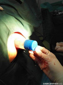 男子肛门被插15厘米胶水瓶 3名医生取了40分钟