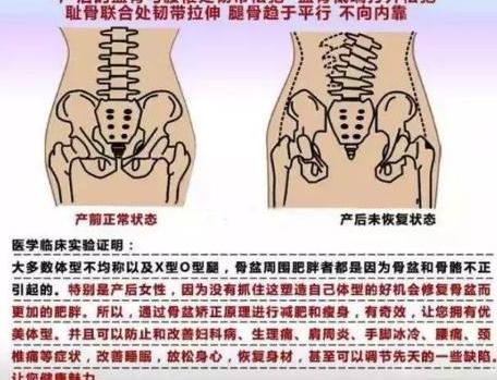 产后骨盆修复,你听说过徒手骨盆修复吗