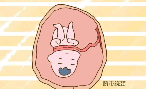 胎儿脐带绕颈,和孕妈3个坏习惯息息相关,要是有赶紧改正
