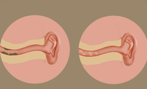 耳朵总是痒,不一定是耳屎在作怪 哪些原因会引起耳朵瘙痒