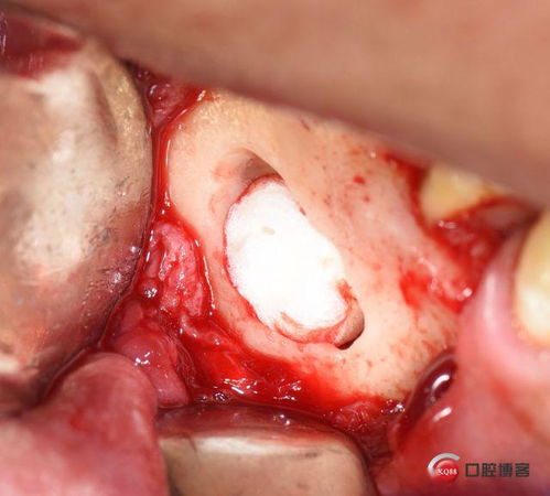 从微创到精准 后牙根尖囊肿摘除 根管倒充填手术