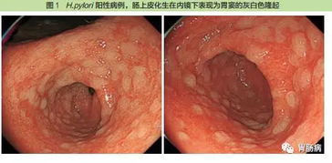 肠化生与胃癌到底有多大关系 