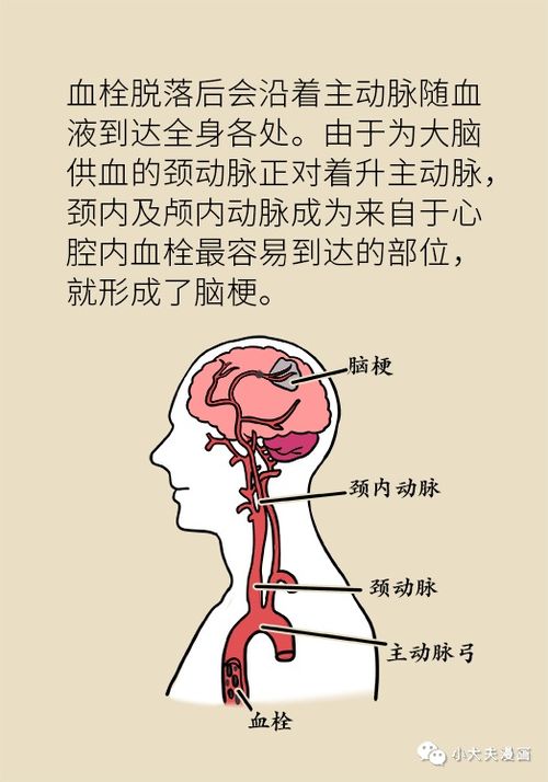 中国房颤日 脑梗风险增高十倍 很多人得病还不自知 