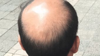 脱发的人头皮都变硬了,植发还能成活吗 专家告诉你答案