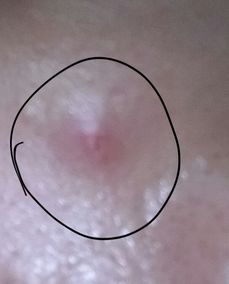 求专业人士回答 我这是痘印,长了大概有2个月了,属于囊肿痘留下来的,我用消毒过的粉刺针刺破清理 