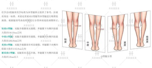 北京最好自体脂肪矫正腿型专家关几梦 O型腿怎么矫正更好