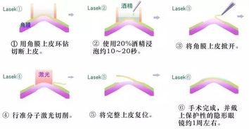 角膜屈光手术知多少