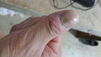 请医生帮忙看下这是怎么了,我的手指头一到下半年就开始干硬,手就不停的剥皮,指甲也高低不平,,这样的 