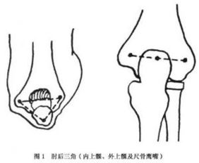 肘关节脱位