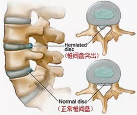 腰椎间盘突出 专业康复导师带你缓解训练,还有八条生活中的建议