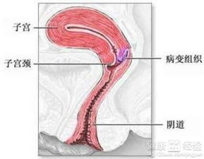 宫颈癌术后的存活期