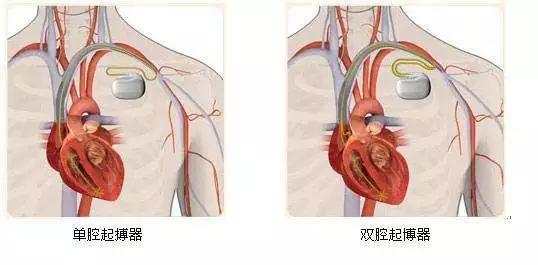 高龄老人可以安装起搏器吗 论心脏起搏器的起源 风险及注意事项