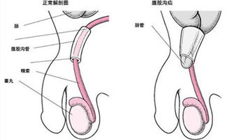 婴幼儿疝气带有副作用吗(婴儿疝气带的佩戴方法视频)