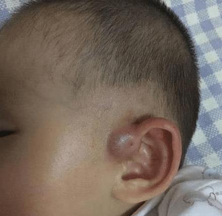 为何有的新生儿耳朵有 小孔 真是寓意着有福气 其实恰恰相反