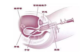 胎停育两次，医生建议做个宫腔镜，是不是必须做的呢做完宫腔镜后，多久可以怀孕呢
