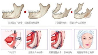 是否有必要进行手术去除脸部脂肪粒？