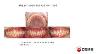 移植手术辅助的阻生尖牙的牵引助萌