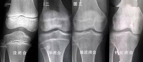 断骨为长高,16万买来7.2cm和一身 残疾 如果他能早学点中医知识