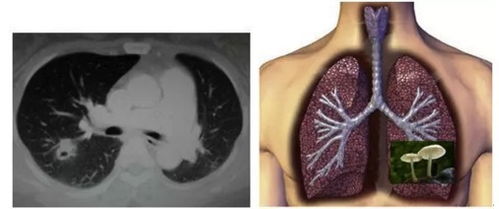 肺部有癌,身体先知 身体露出4个 丑态 ,可能癌细胞来访