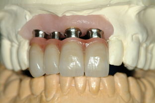 补牙挂什么科 蛀牙去补牙，应该挂哪一个号，只有三个选项，但是不知道挂哪一个？ 